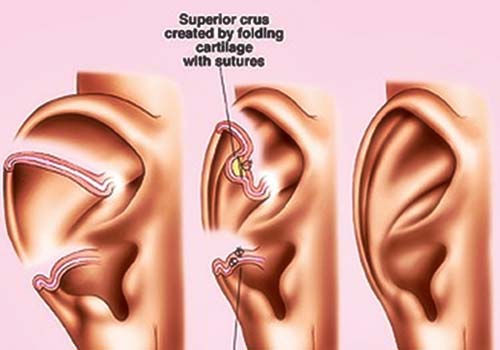 Ear Correction Surgery in Hyderabad, India