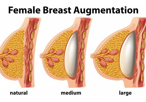 Breast Augmentation Treatment in Hyderabad,Breast Implants