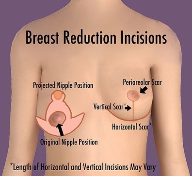 Breast Reduction Surgeons in Chennai - Reviews, Cost, Success Rate