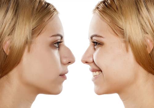 Nose Surgery in Hyderabad, India